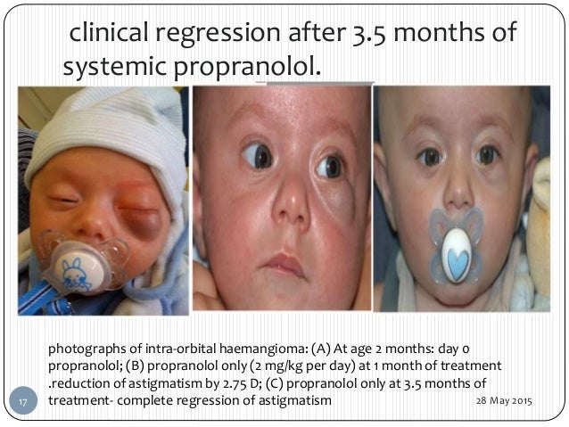 Aes bondage production Severe facial hemangeomas